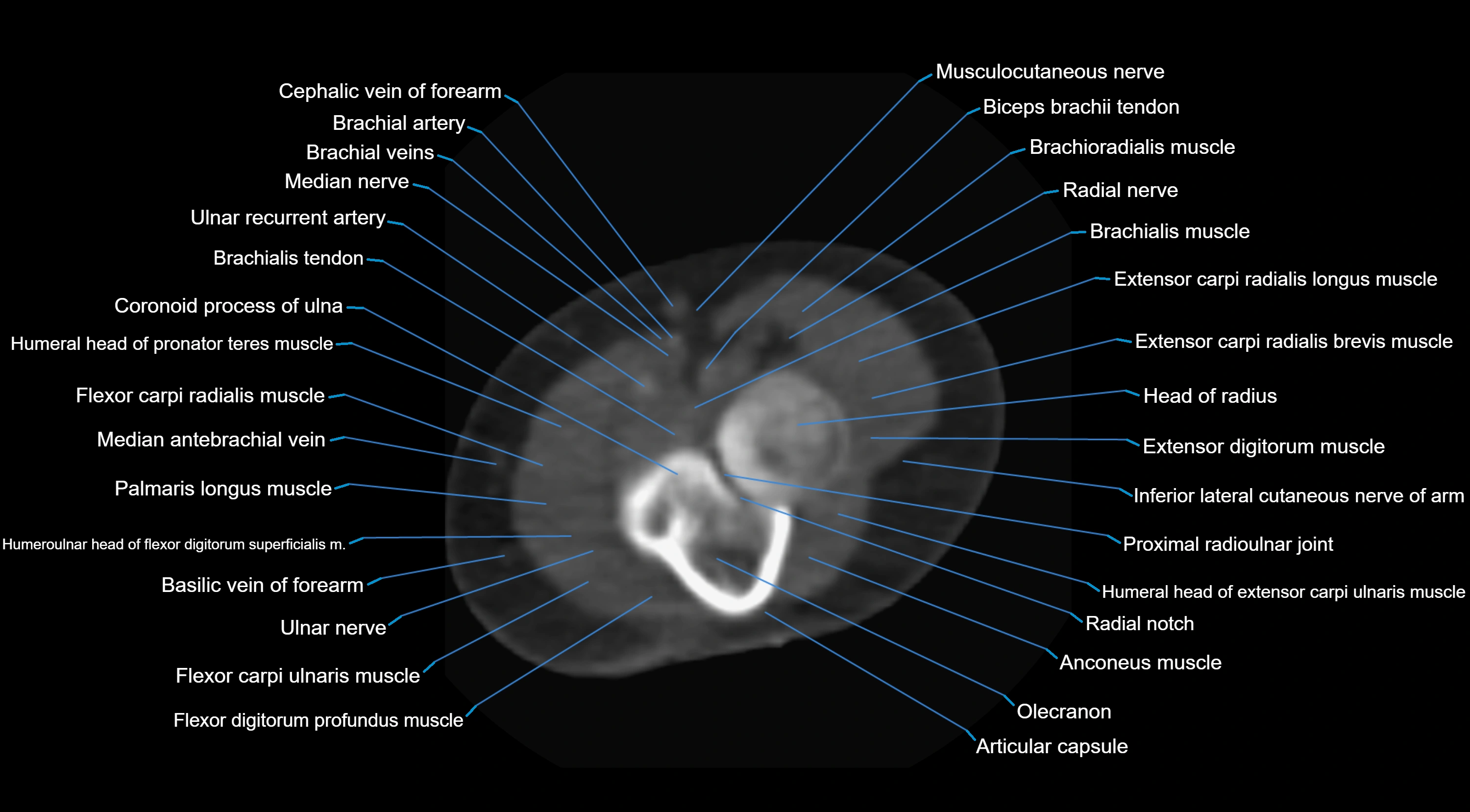 CT elbow axial  cross sectional anatomy labelled  radiology image -00031.webp